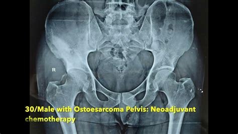 hemipelvectomy female|hemipelvectomy surgery.